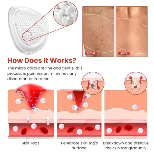 ( Buy 1 Get 1 Free ) Derma Smooth Skin Tag Removal Patch